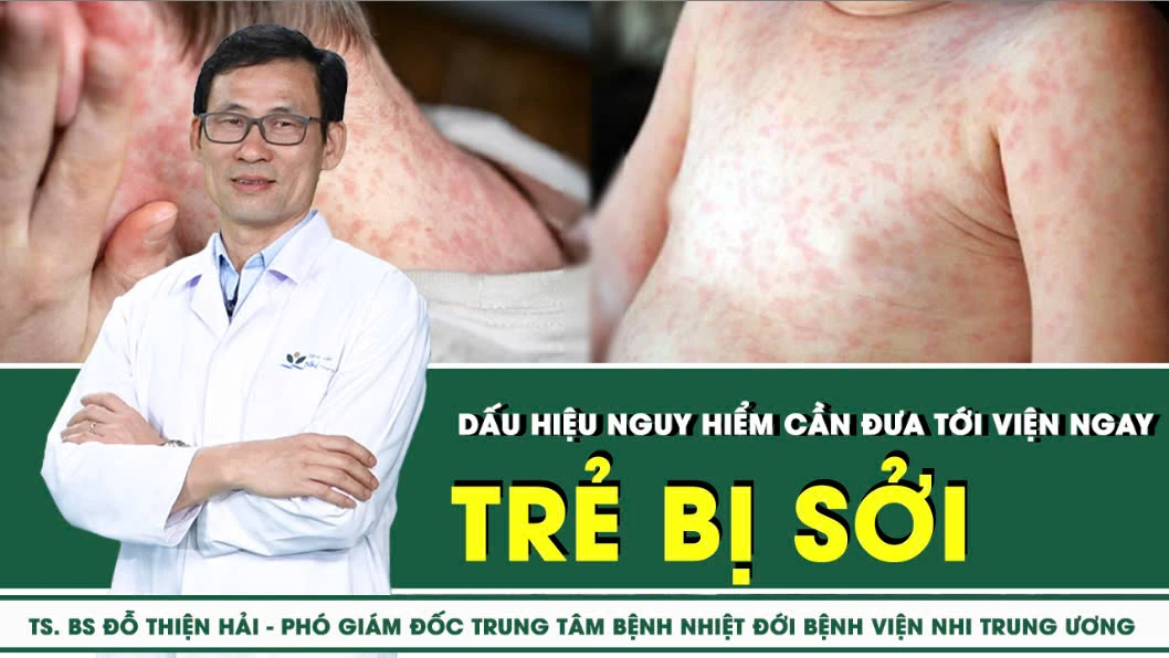 Trẻ bị sởi: dấu hiệu nguy hiểm cần đưa đến viện ngay